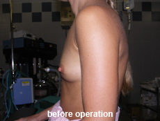 plastic-surgery-breast-augmentation 